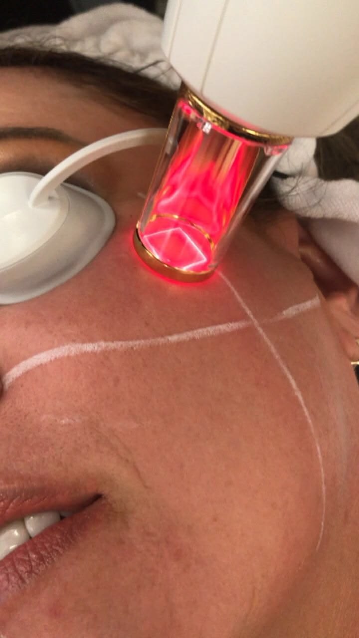 laser CO2 laser CO2
